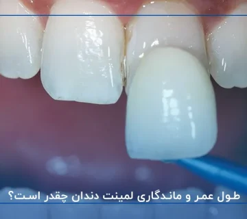 طول عمر و ماندگاری لمینت دندان چقدر است؟