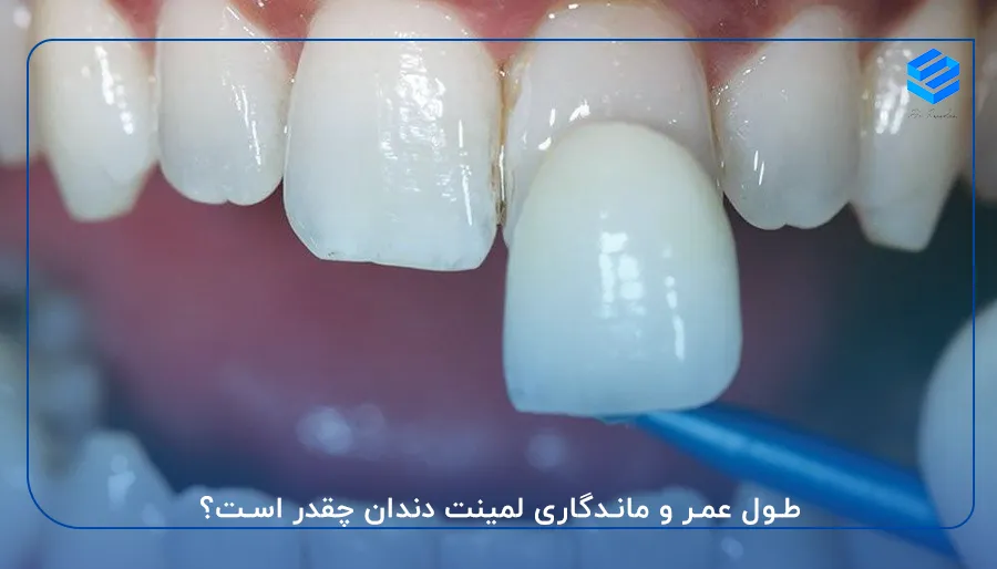 طول عمر و ماندگاری لمینت دندان چقدر است؟