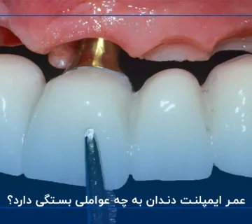 عمر ایمپلنت دندان به چه عواملی بستگی دارد؟