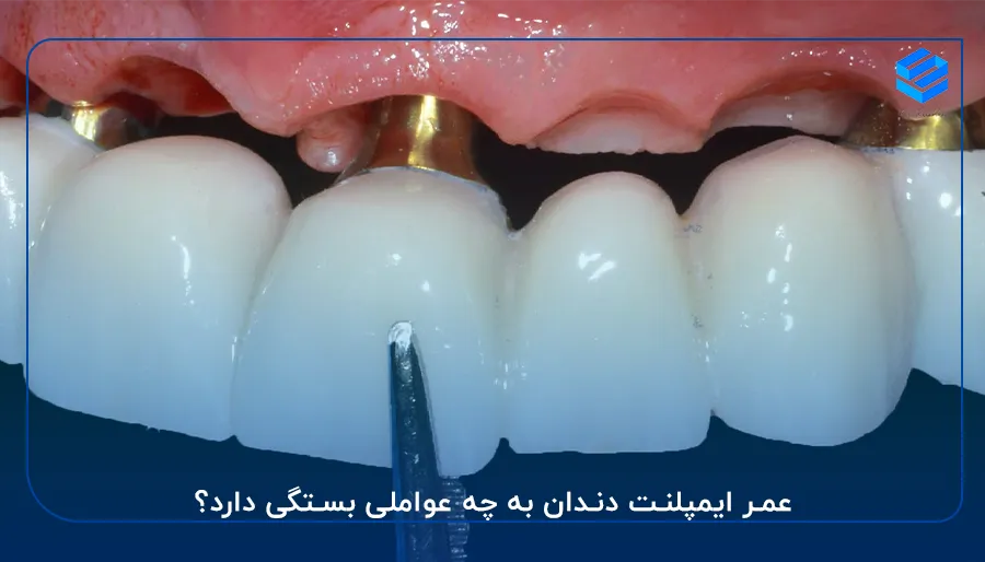 عمر ایمپلنت دندان به چه عواملی بستگی دارد؟