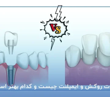 تفاوت روکش و ایمپلنت چیست و کدام بهتر است