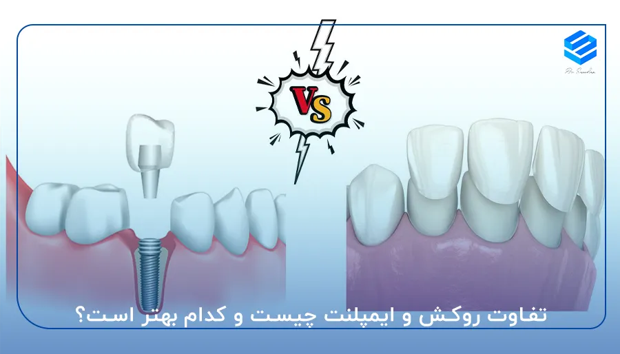 تفاوت روکش و ایمپلنت چیست و کدام بهتر است
