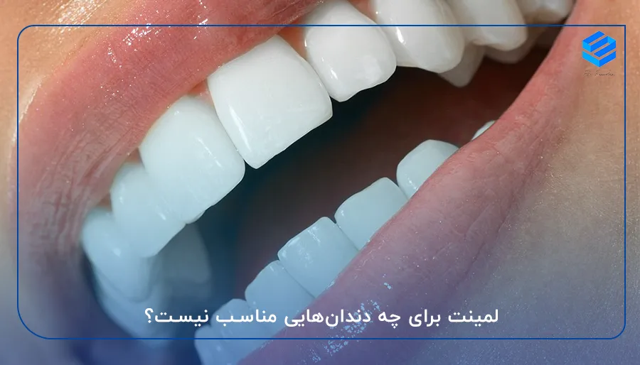 لمینت برای چه دندان‌هایی مناسب نیست؟