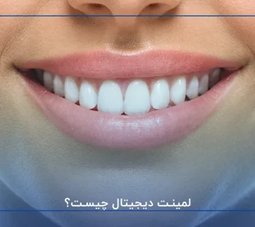 لمینت دیجیتال چیست؟