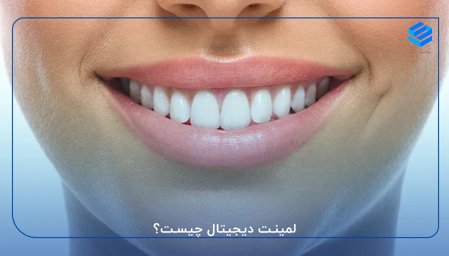 لمینت دیجیتال چیست؟