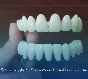 مزایا و معایب لمینت متحرک دندان