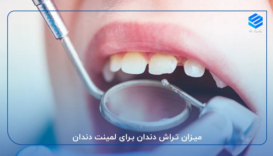 میزان تراش دندان برای لمینت دندان