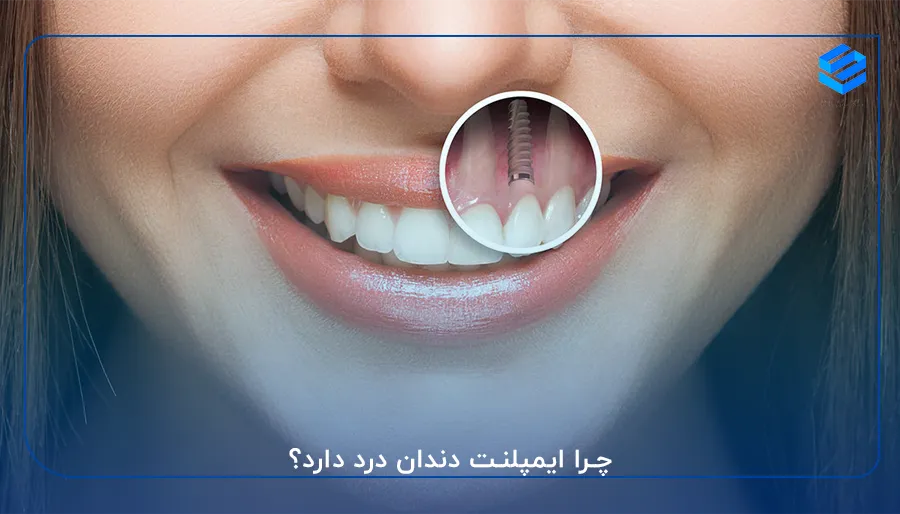 چرا ایمپلنت دندان درد دارد؟
