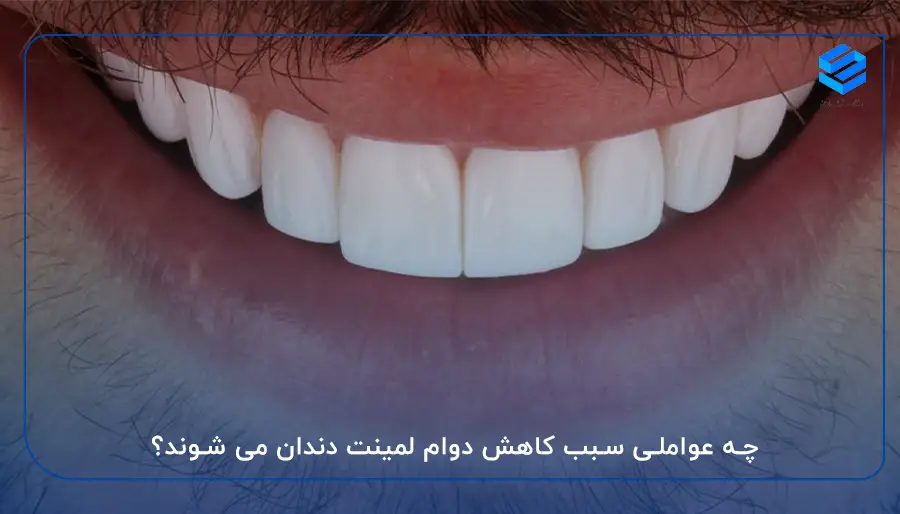 چه عواملی سبب کاهش دوام لمینت دندان می‌ شوند؟