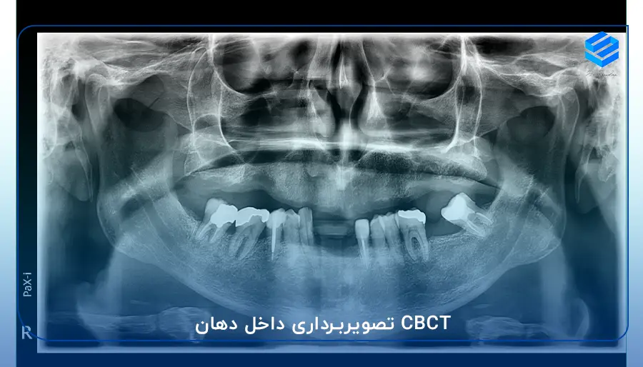 CBCT تصویربرداری داخل دهان