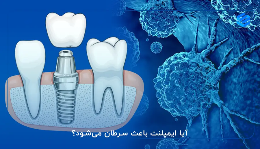 آیا ایمپلنت باعث سرطان می‌شود؟