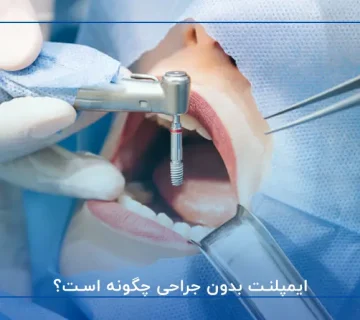 ایمپلنت بدون جراحی چگونه است؟