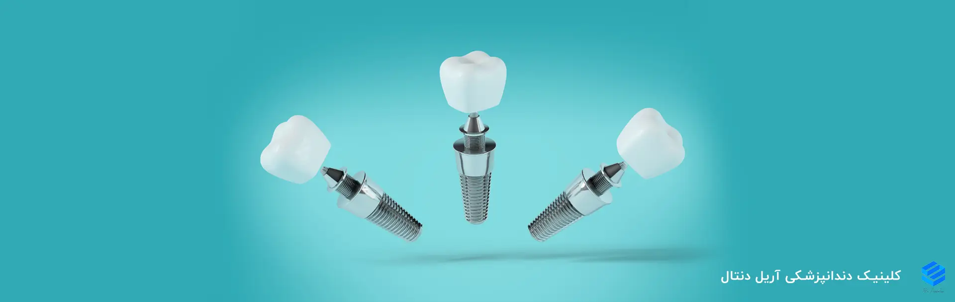 ایمپلنت دیجیتال