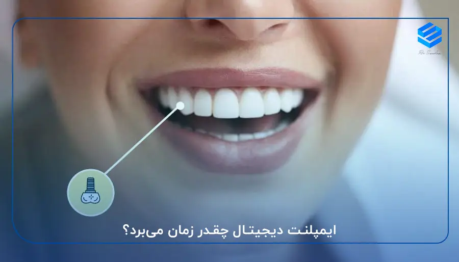 ایمپلنت دیجیتال چقدر زمان می‌برد؟