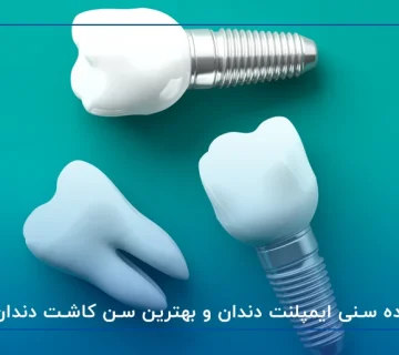 سن مناسب ایمپلنت دندان