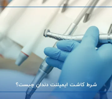 شرایط ایمپلنت دندان
