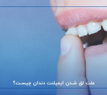 علت لق شدن ایمپلنت دندان چیست؟