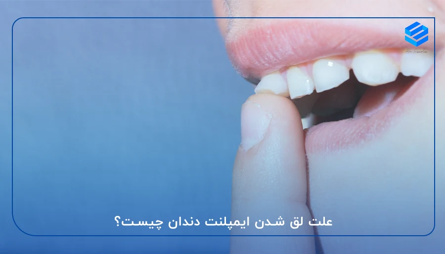 علت لق شدن ایمپلنت دندان چیست؟