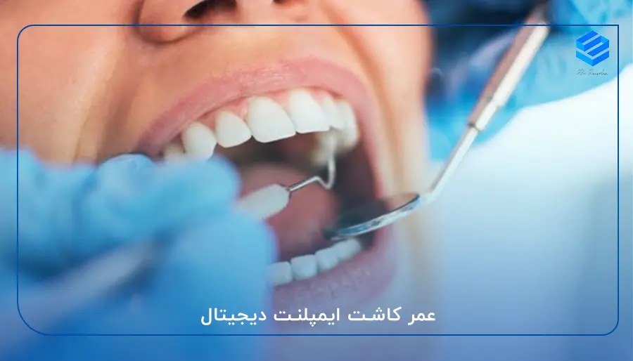 عمر کاشت ایمپلنت دیجیتال