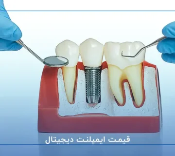قیمت ایمپلنت دیجیتال