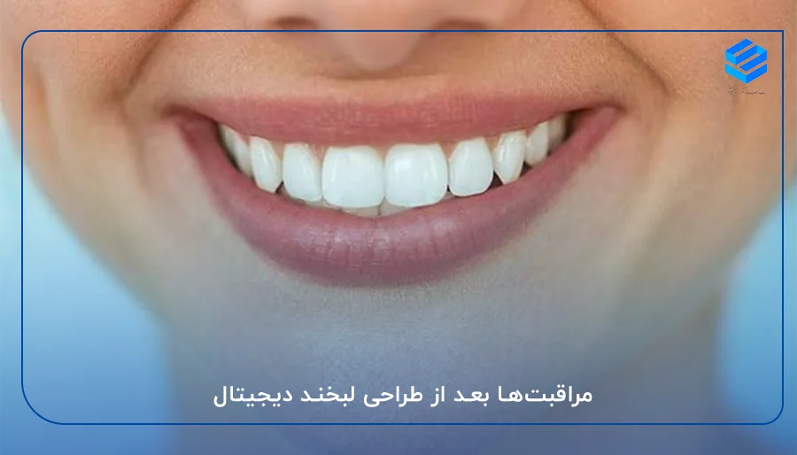 مراقبت‌ها بعد از طراحی لبخند دیجیتال