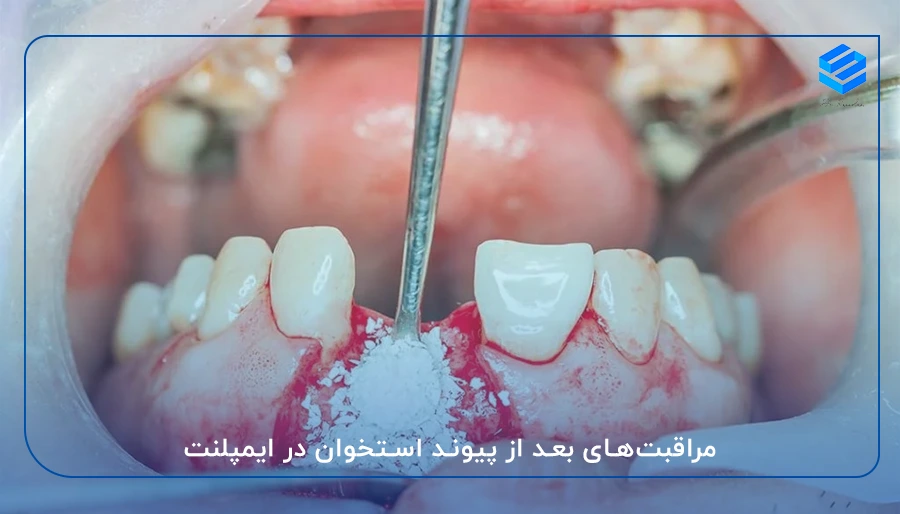 مراقبت‌های بعد از پیوند استخوان در ایمپلنت