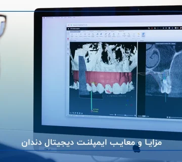 مزایا و معایب ایمپلنت دیجیتال دندان