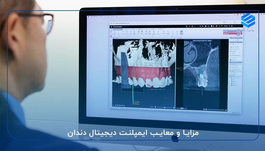 مزایا و معایب ایمپلنت دیجیتال دندان