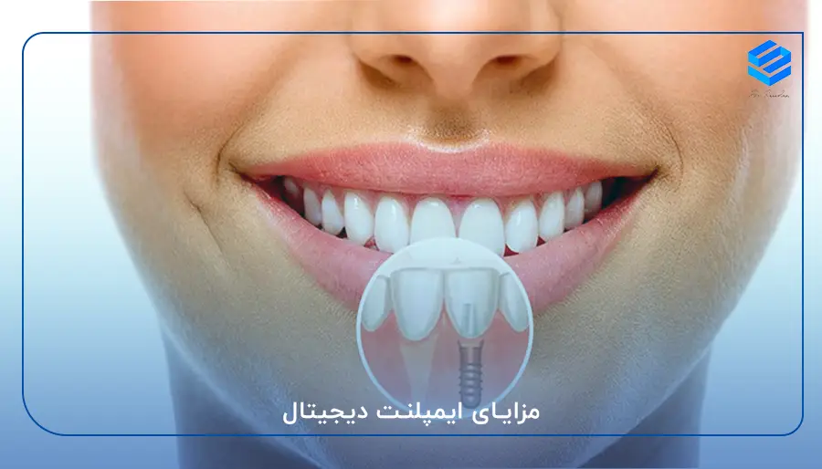 مزایای ایمپلنت دیجیتال