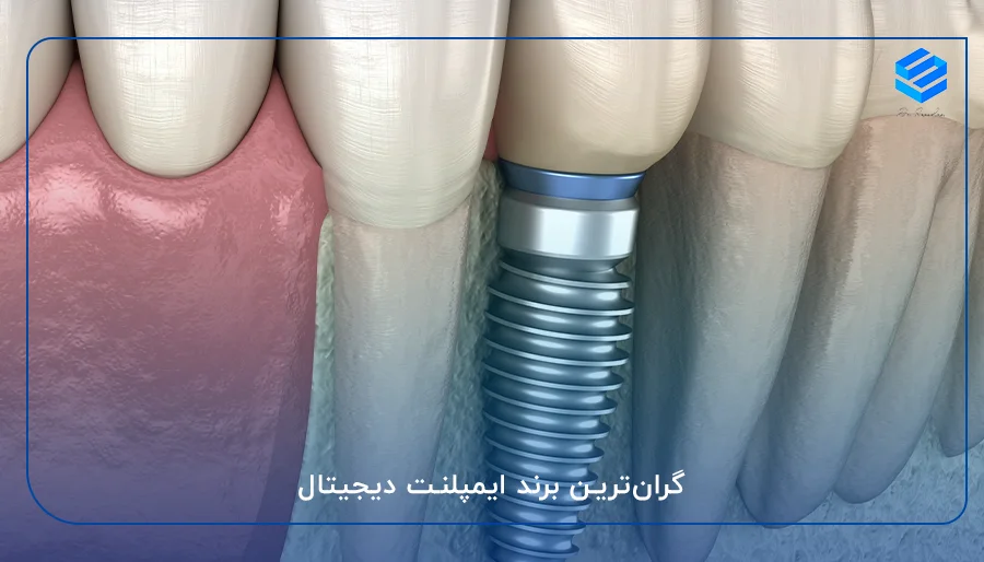 گران‌ترین برند ایمپلنت دیجیتال