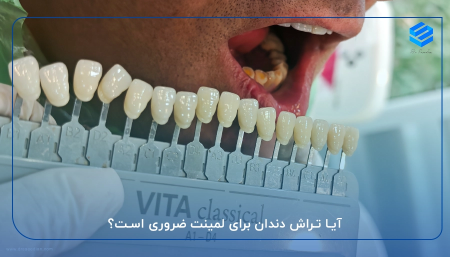 آیا تراش دندان برای لمینت ضروری است؟