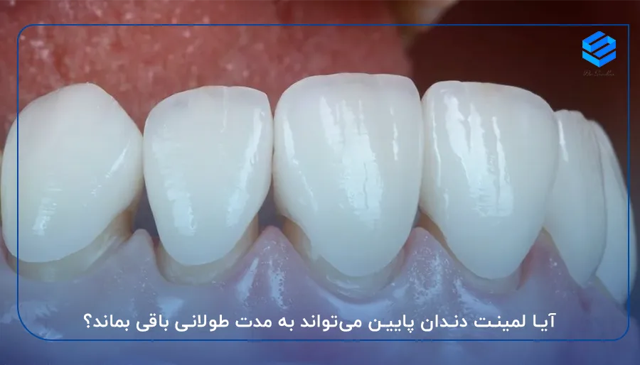 آیا لمینت دندان پایین می‌تواند به مدت طولانی باقی بماند؟