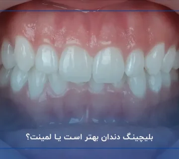 بلیچینگ دندان بهتر است یا لمینت؟