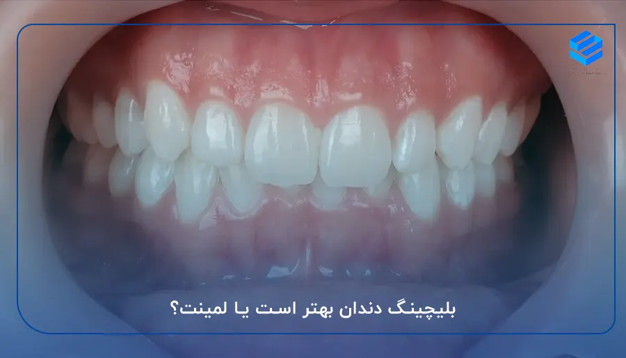 بلیچینگ دندان بهتر است یا لمینت؟
