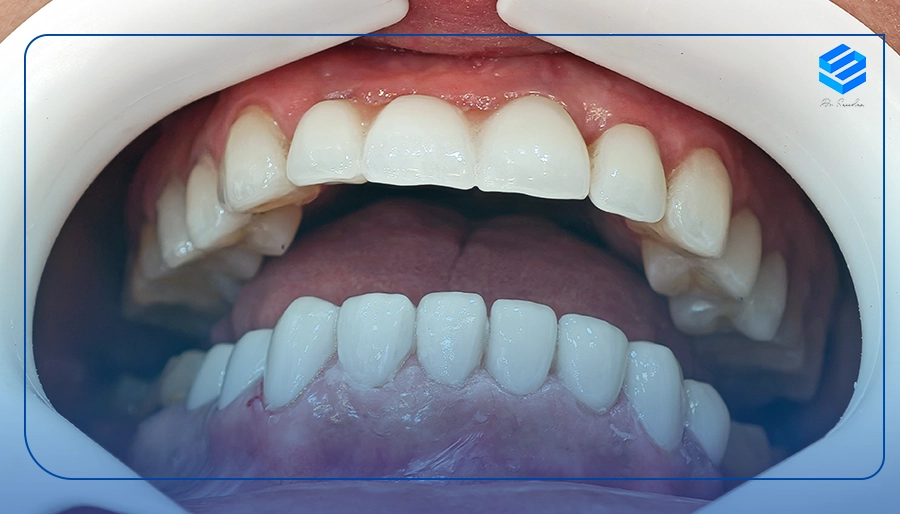 بهترین لمینت کار دندان