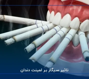 تاثیر سیگار بر لمینت دندان