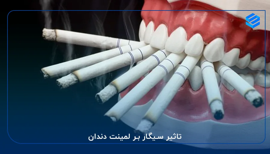 تاثیر سیگار بر لمینت دندان