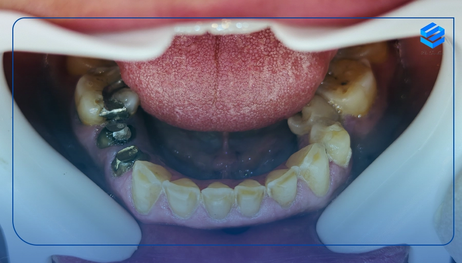 ترمیم ظاهر دندان
