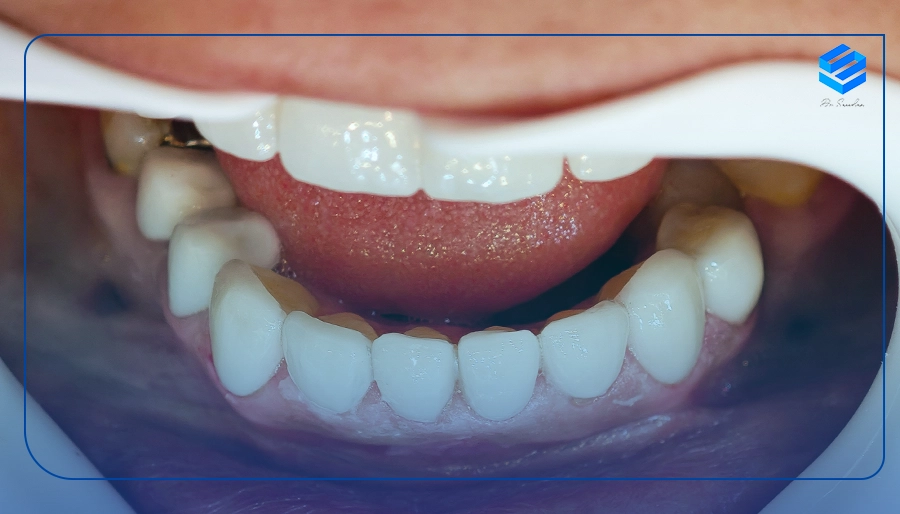 عکس لمینت دندان