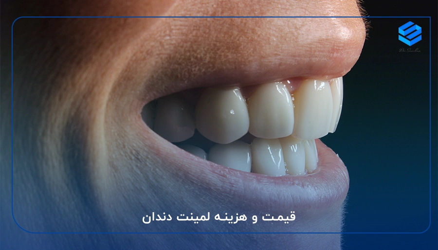 قیمت و هزینه لمینت دندان
