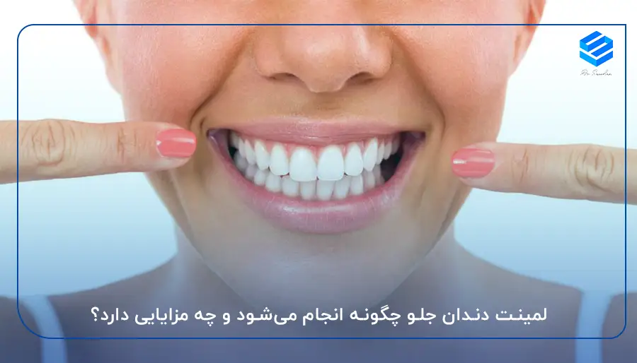 لمینت دندان جلو چگونه انجام می‌شود و چه مزایایی دارد؟