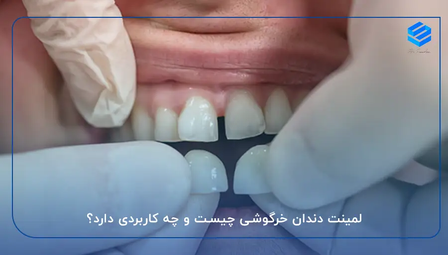 لمینت دندان خرگوشی چیست و چه کاربردی دارد؟