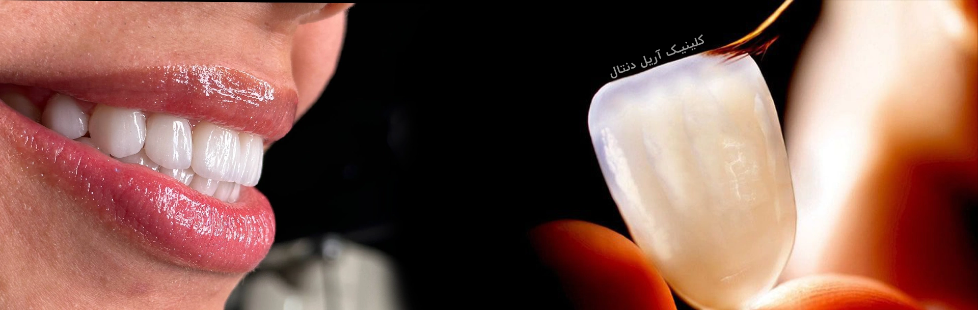 لمینت دندان در تهران