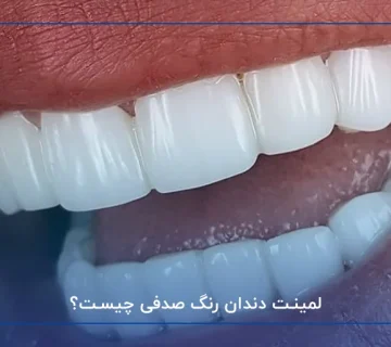 لمینت دندان رنگ صدفی چیست؟