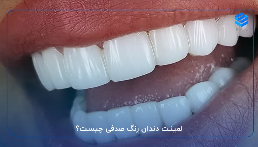 لمینت دندان رنگ صدفی چیست؟