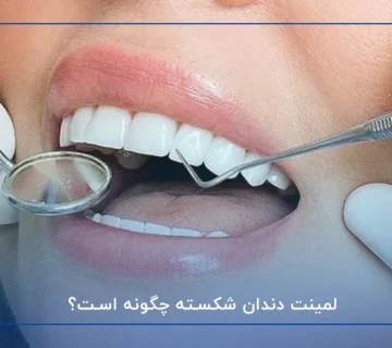 لمینت دندان شکسته چگونه است؟