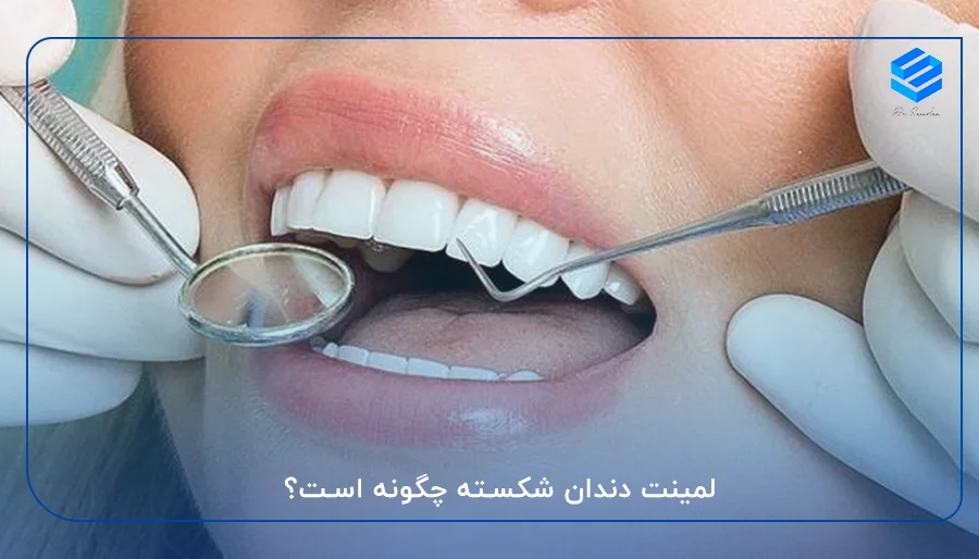لمینت دندان شکسته چگونه است؟
