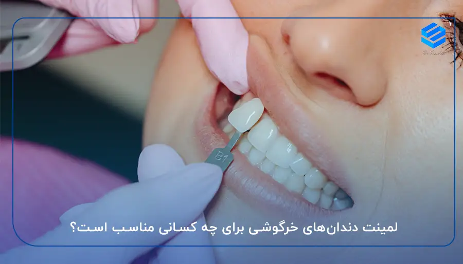 لمینت دندان‌های خرگوشی برای چه کسانی مناسب است؟