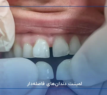 لمینت دندان‌های فاصله‌دار