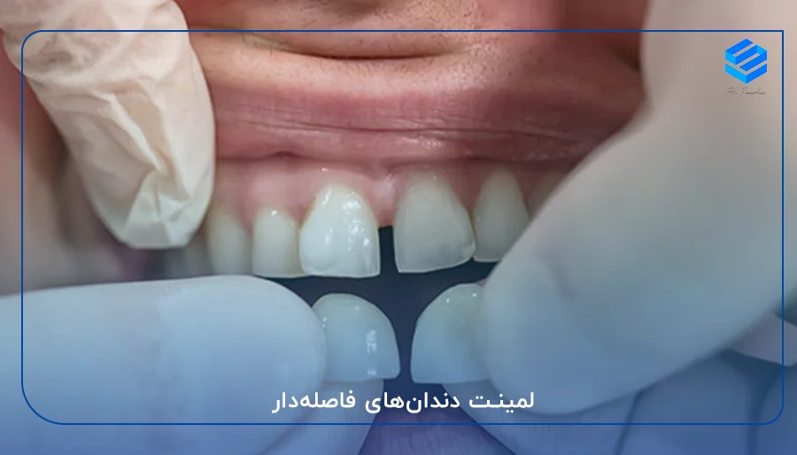لمینت دندان‌های فاصله‌دار